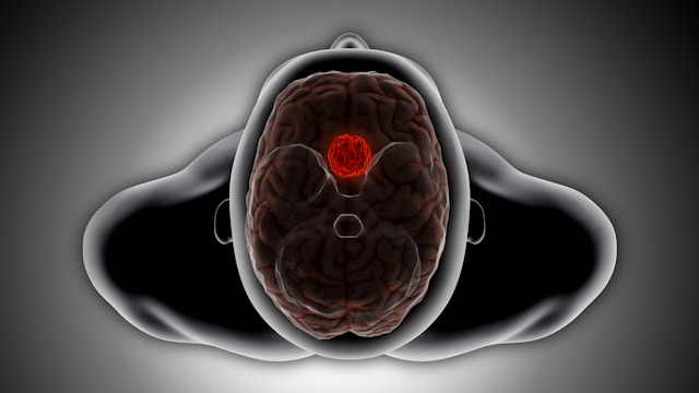 Graphic representation of neurodegenerative diseases